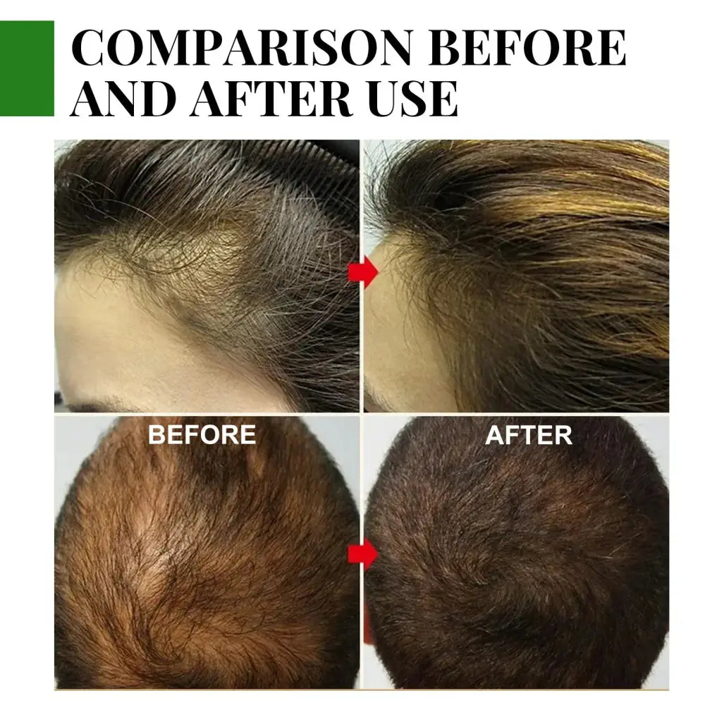 Eelhoe Rosemary Essential Oil for Hair Growth and Scalp Care